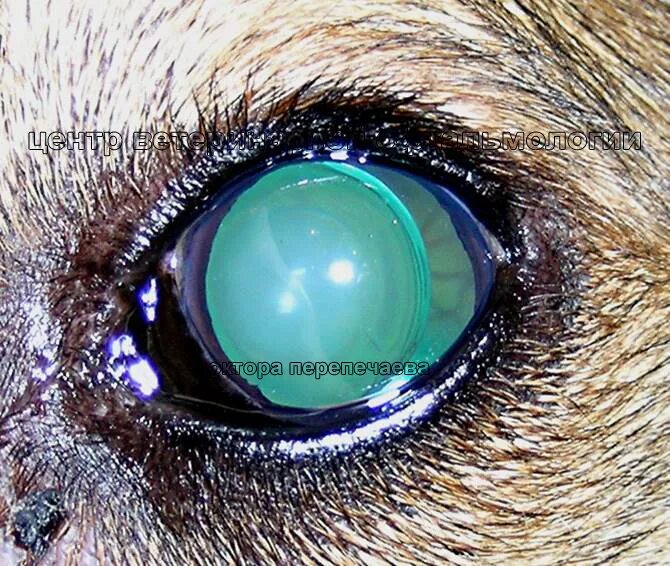 сублюксация хрусталика
