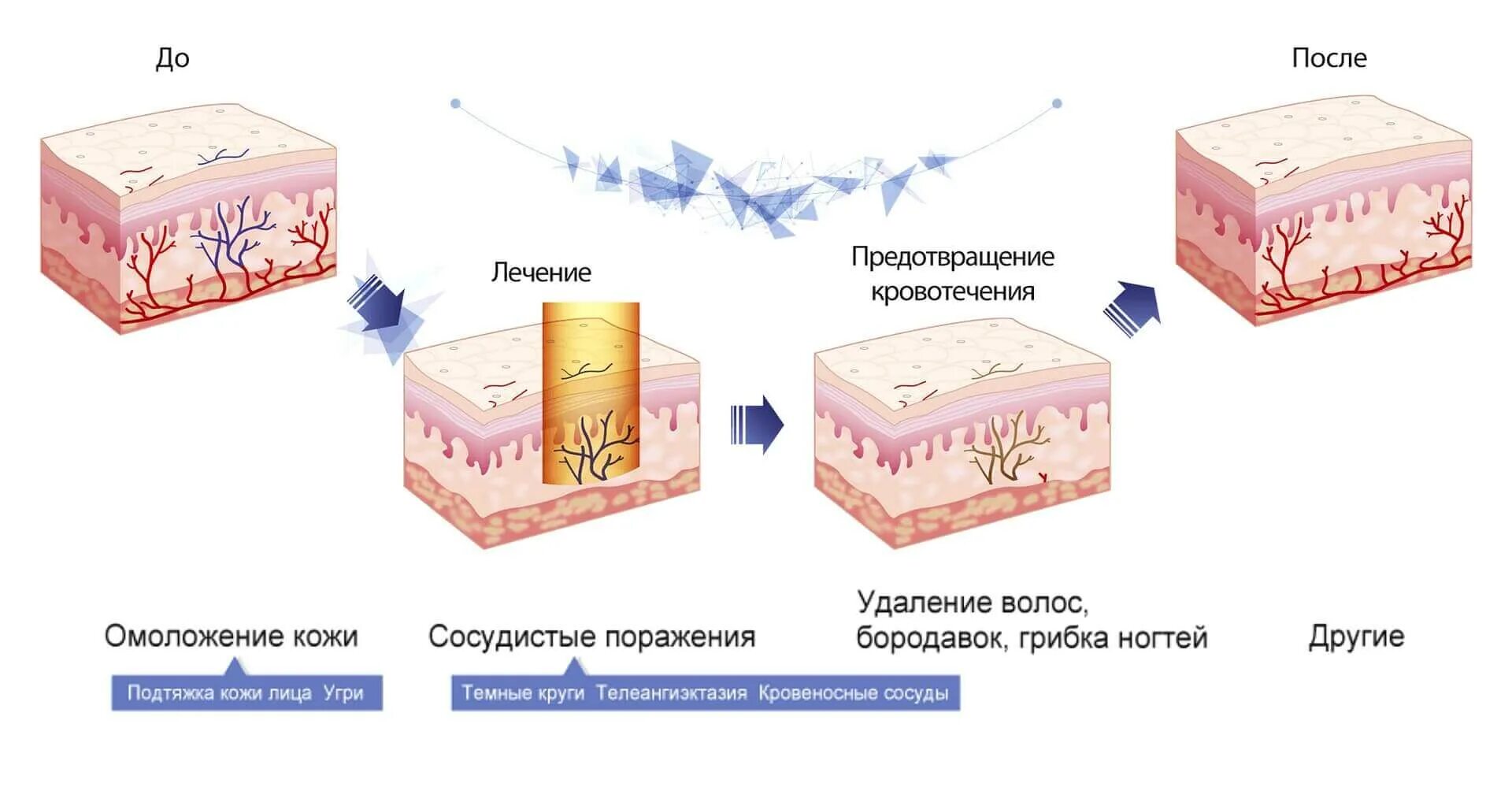 Сосудистые звездочки розацеа. Коагуляция сосудов неодимовым лазером. Воздействие лазера на кожу. Нарушение регенерации кожи.