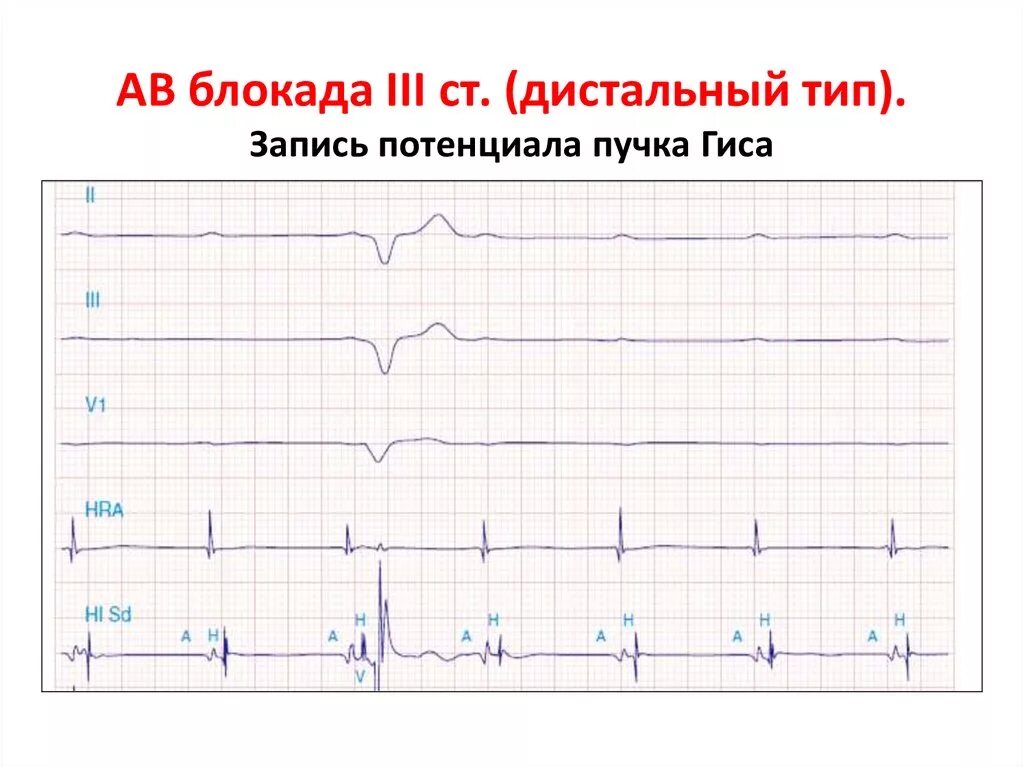 Са блокада типы. Синоатриальная блокада 3 степени на ЭКГ. Са блокада 3 ст на ЭКГ. Блокада са узла ЭКГ. АВ блокада III ст.