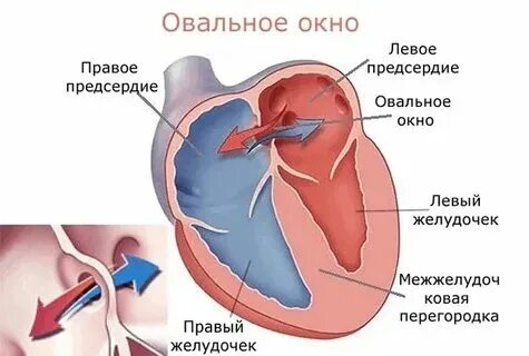 Не закрывается окно у новорожденных. Не закрывается окно у новорожденных