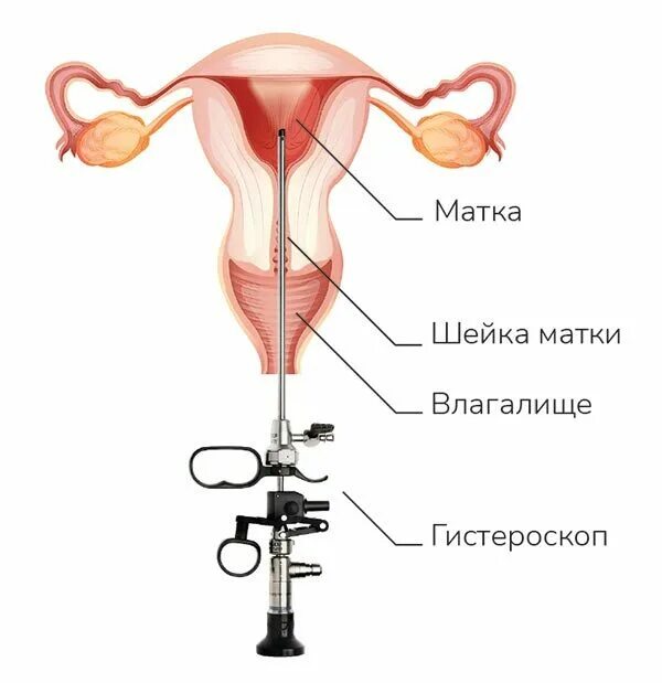 Гистероскопия матки что это такое как проходит. Гистероскопия маточных труб. удаление полипа шейки матки гистероскопом. гистероскопия матки и низкий гемоглобин.