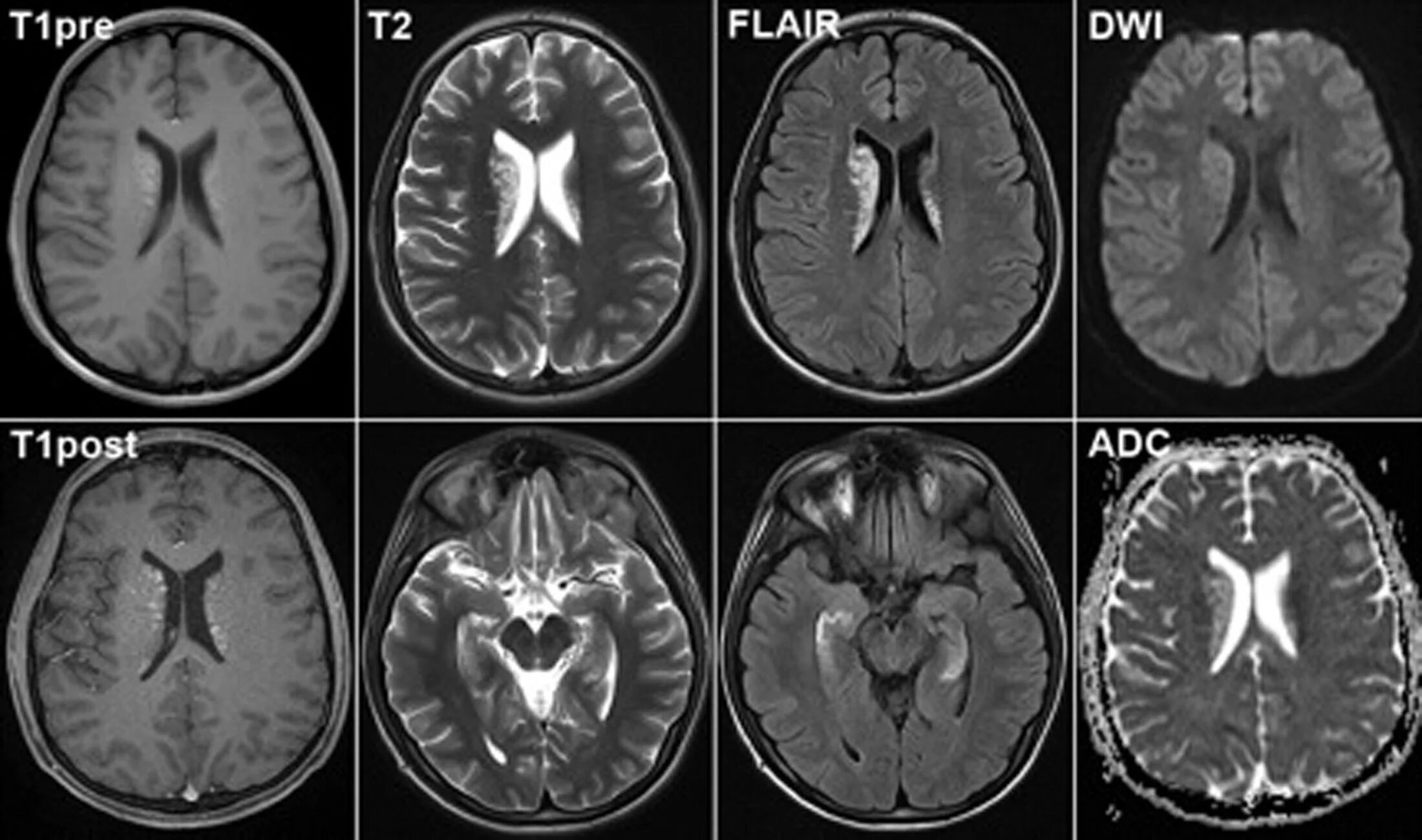 Снимки мрт головного мозга здорового человека. Магнитно резонансные томограммы головного мозга. Мигрень на мрт. Снимок мрт головного мозга в норме.