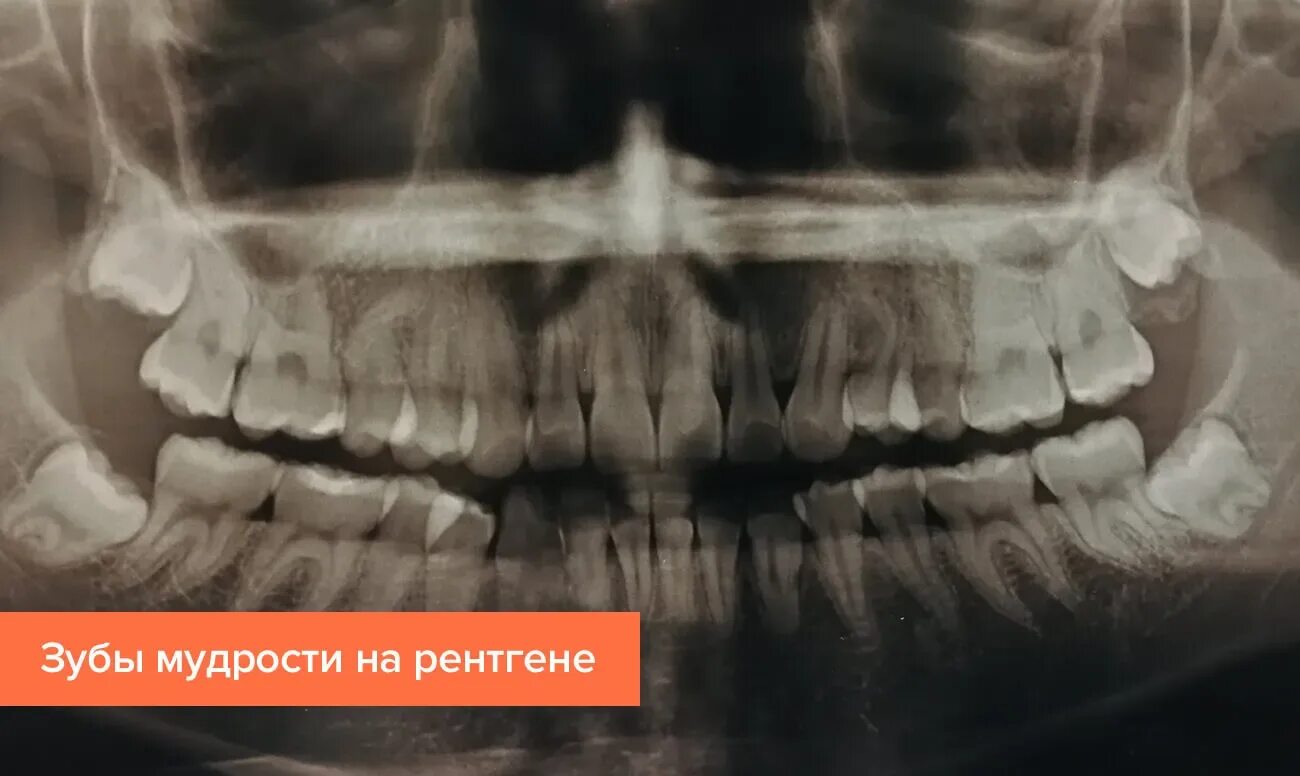 Зуб 8 нижний. Ретинированный зуб мудрости рентген. Ретинированный зуб мудрости на нижней челюсти. Кривой зуб мудрости рентген. Зубы мудрости на нижней челюсти рентген.
