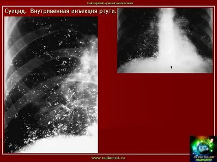 Ртуть в легких