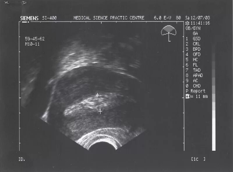 Толщина Мэхо эндометрия норма. М Эхо толщиной 8 мм. М-Эхо: 1.9 мм. М-Эхо-толщина 9,4мм. Эндометрий 3 мм