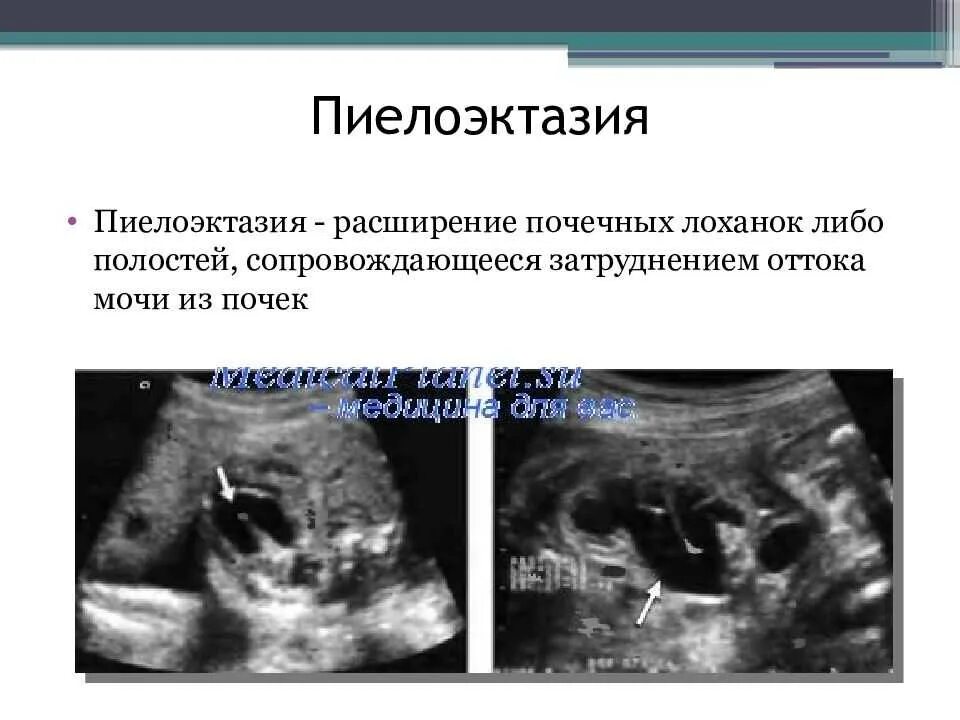 Операция при гидронефрозе почки у детей. Расширение лоханки почки пиелоэктазия. Пиелоэктазия правой почки у взрослого что это. Пиелоэктазия почек узи. Гидрокаликоз почек у детей.