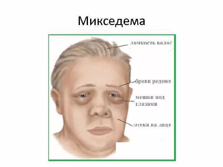 Микседема щитовидной железы. Микседема слизистый отек.