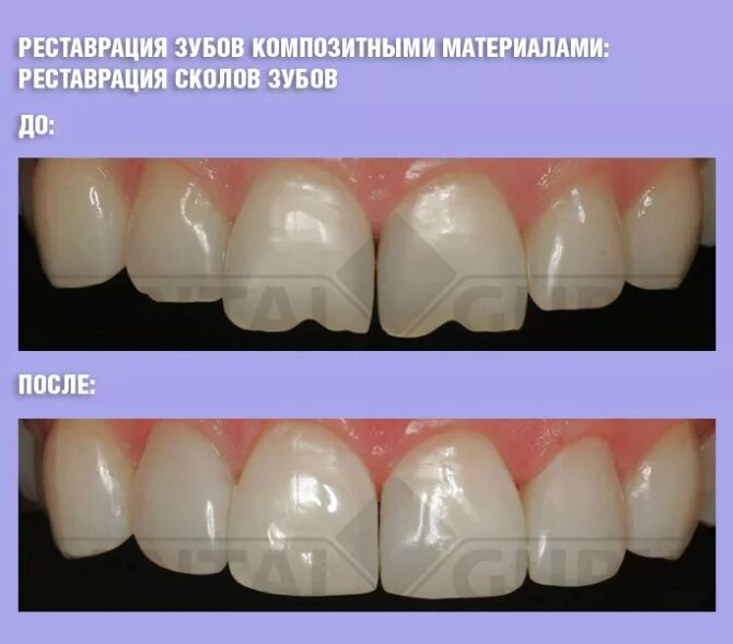 Композиты для передних зубов. Восстановление зубов композитными материалами. Восстановление передних зубов. Реставрация передних зубов композитным материалом.