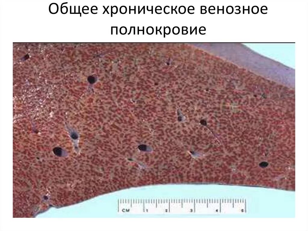 Печень при хроническом венозном застое. Венозное полнокровие печени мускатная печень. Мускатная печень патологическая анатомия. Мускатная печень гистология. Венозное полнокровие печени макропрепарат.