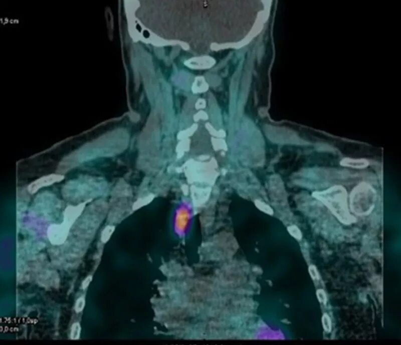 Метастазы при раке щитовидной железы. Кт метастаз щитовидной железы. ОФЭКТ кт паращитовидных желез. Опухоль щитовидной железы кт.