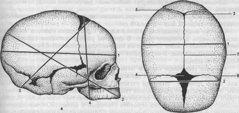 Швы и роднички головки плода. Швы и роднички головки плода Акушерство. Размеры головки плода. Головка новорожденного Акушерство.