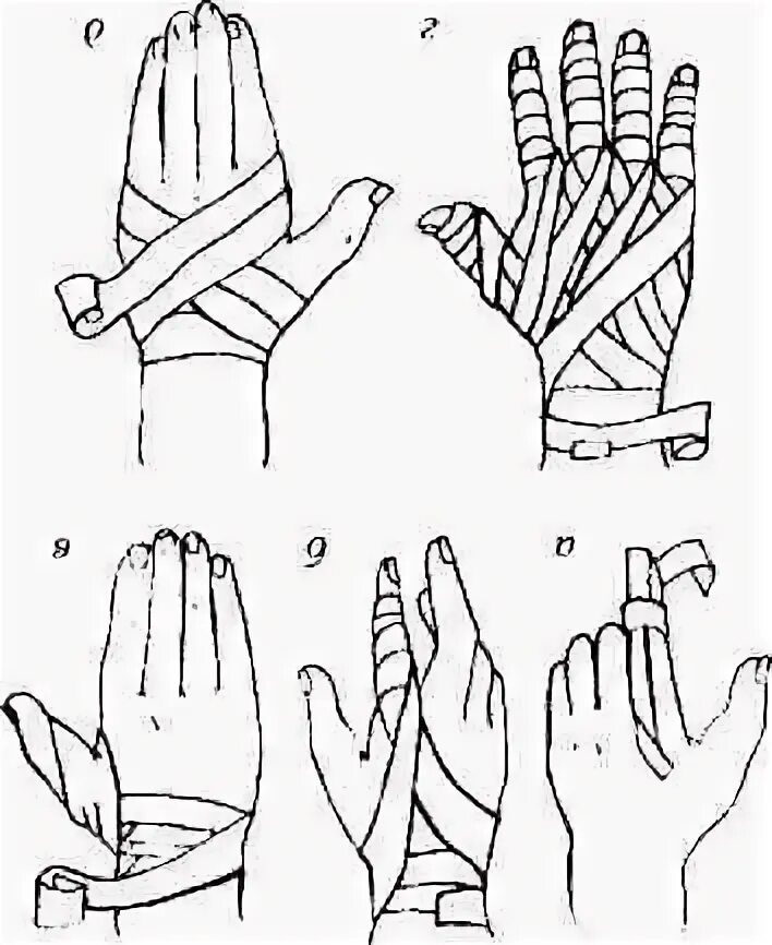 Техника наложения повязки перчатка