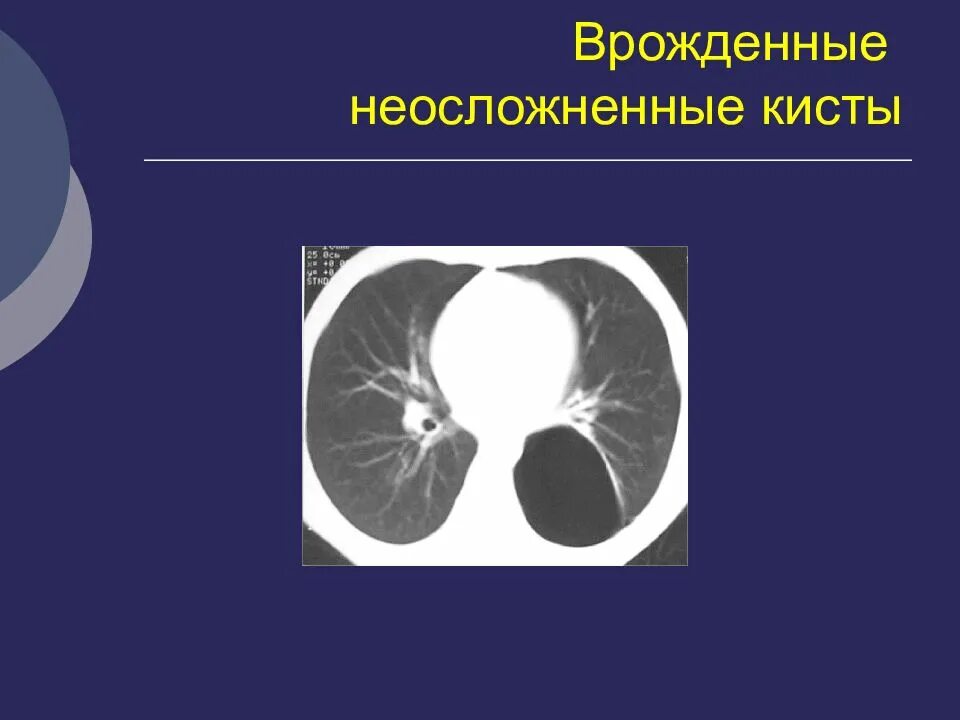 Врожденные кисты легких. Пороки развития бронхолегочной системы. Врожденная бронхогенная киста легкого. Врожденная киста легкого. Врожденные кисты легких.