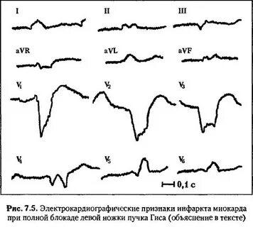 Инфаркт миокарда блокады
