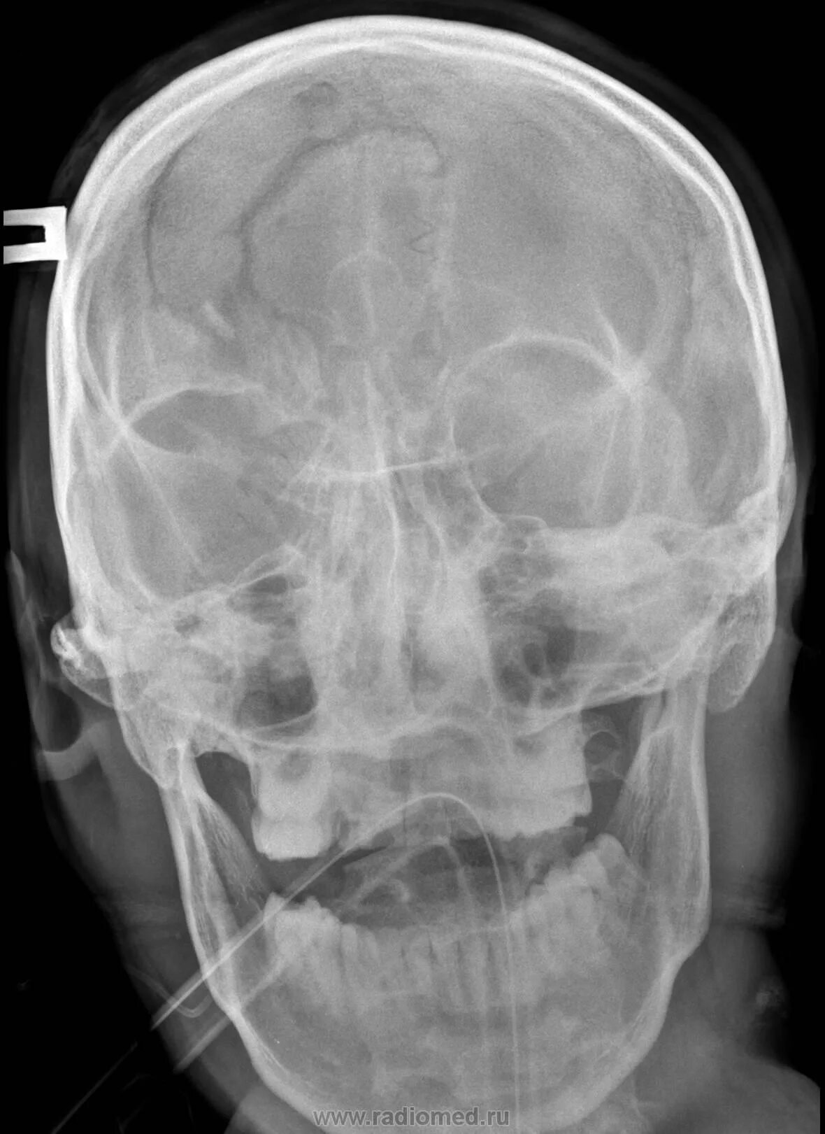 Кости черепа рентген. Перелом костей основания черепа рентген. Перелом свода черепа рентген. Перелом черепа на рентгене лобной кости. Перелом свода черепа кт.