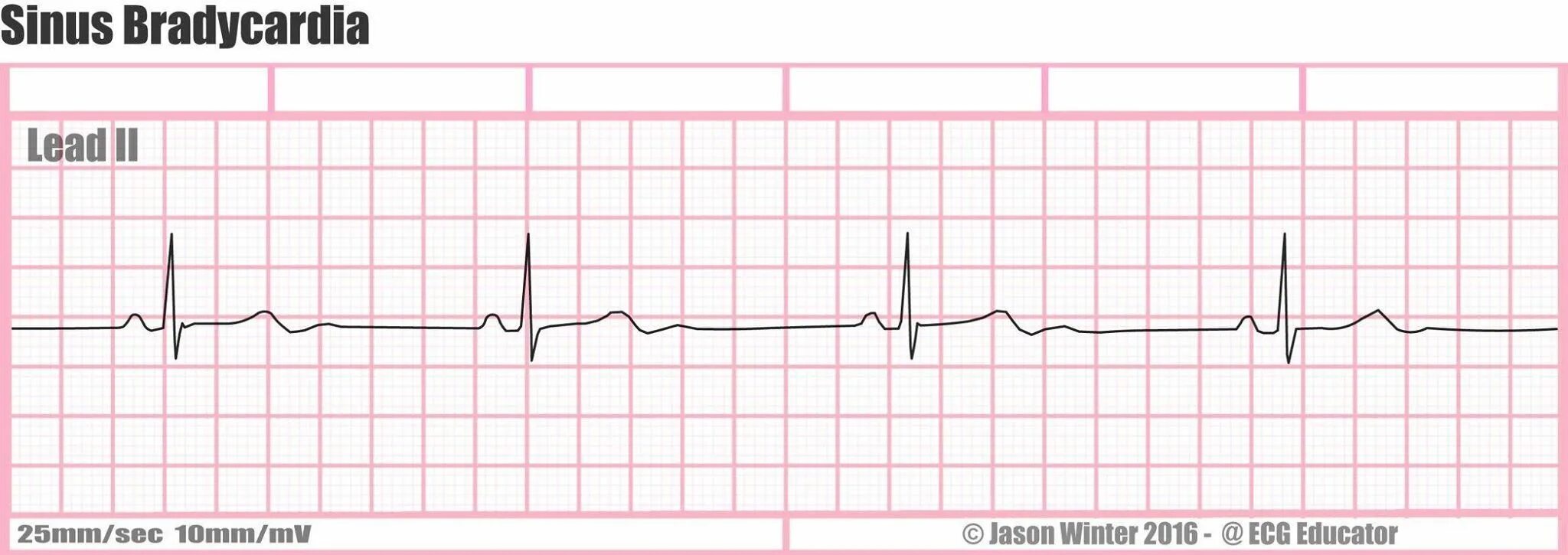 Брадикардия какое давление. Синусовая брадикардия на экг. sinus bradycardia ecg. брадикардия снимки. брадикардия фото.