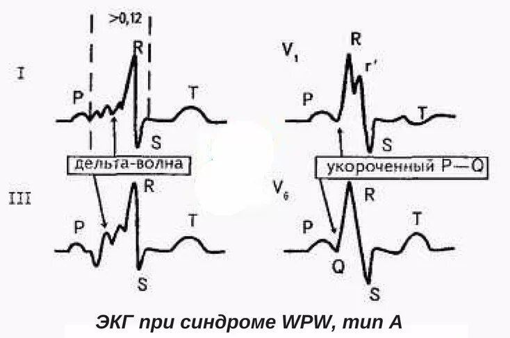 Кардиограмма синдромов. Диагностические экг критерии синдрома бругада. Синдром бругада экг пациентов. Синдром укорочения интервала pq на экг. Дельта волна при впв синдроме на экг.