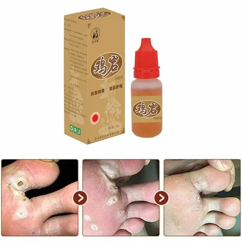 Удалить бородавку мазью. Средство от бородавок. Веррукацид и ферезол. Средство для прижигания бородавок. Капли от бородавок веррукацид.