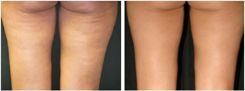 Липолитики в ноги до и после отзывы Inner thigh liposuction before and after 5