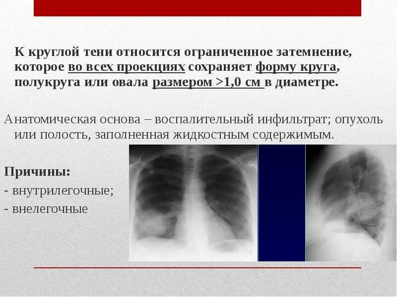 Округлое затемнение. Ограниченное затемнение легких. Синдром ограниченного затемнения легочного поля. Синдром круглой тени рентген.