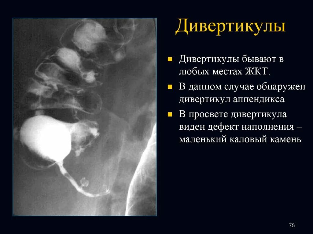 Дивертикул подвздошной кишки. Дивертикул червеобразного отростка. Дефект наполнения дивертикула пищевода. Дивертикулы пищеварительного тракта.