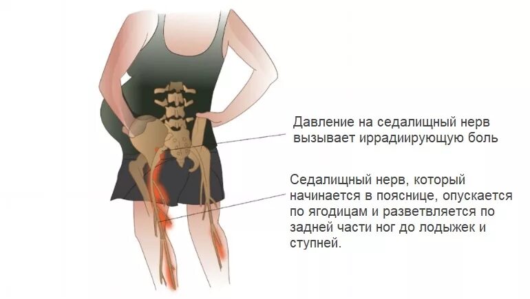 Болит поясница 2 триместр. Седалищный нерв при беременности 3. Защемление седалищного нерва при беременности упражнения. Зажатие седалищного нерва при беременности. Защемило седалищный нерв у беременной.