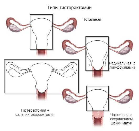 Тотальная гистерэктомия. Радикальная гистерэктомия.