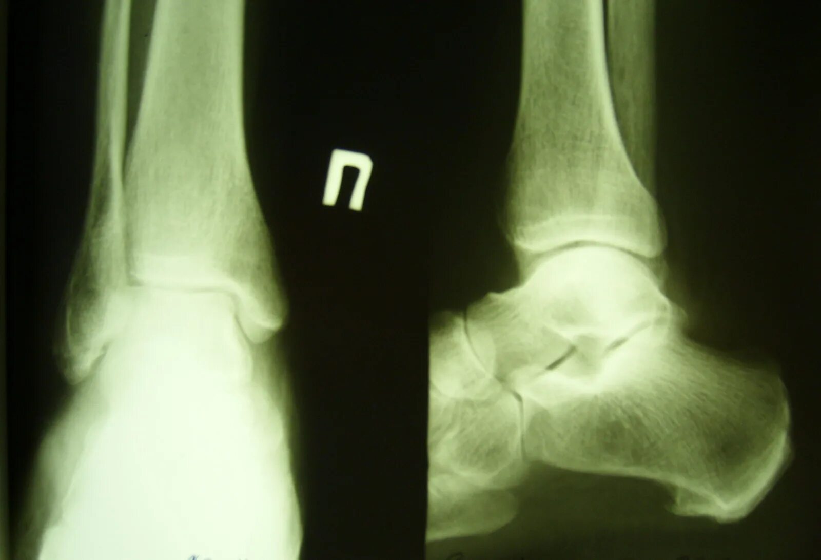 Вывих голеностопного сустава. Передняя таранно малоберцовая связка голеностопного сустава. Голеностопный сустав анатомия строение связки голеностопа. Связочный аппарат голеностопного сустава. Таранно малоберцовая связка.