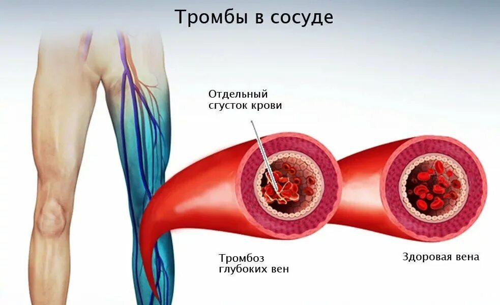 Что значит оторвался тромб у человека. Что значит оторвался тромб у человека