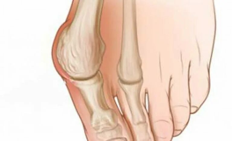 Почему щелкают ноги. Бурсит вальгусной косточки. Косточка на большом пальце. Сустав большого пальца ноги.