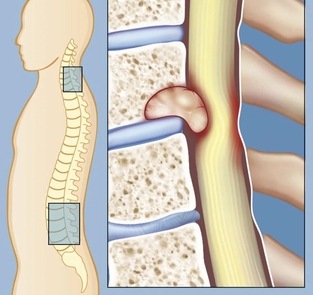 Позвоночник припухлость