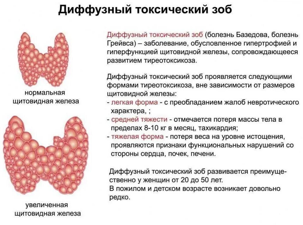 Диагностика зоба. Дифузионный тосический зоб. Диффузный токсический зоб. Диффузный токсический зоб щитовидной железы. Дмффузный токсический зо..