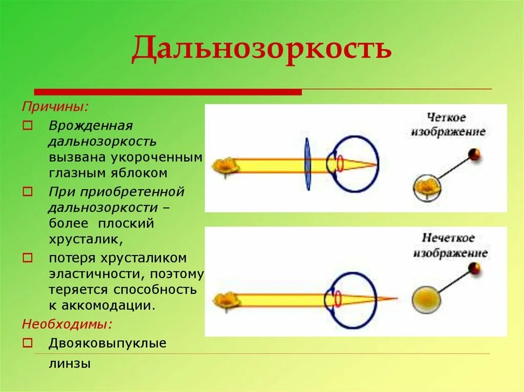 Причины возникновения дальнозоркости. Причины близорукости врожденные и приобретенные. Анатомо-физиологические причины дальнозоркости. Причины возникновения дально. Врожденная и приобретенная близорукость.