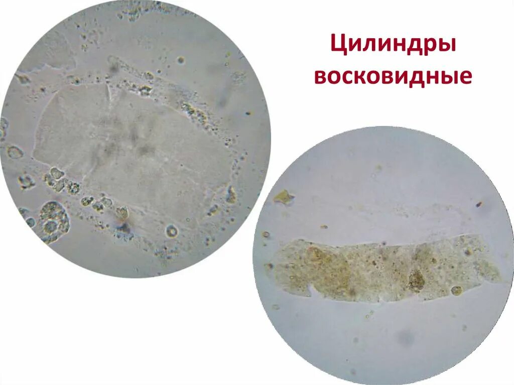 Повышенные цилиндры в моче. Восковидный цилиндр в моче микроскопия. Гиалиновые цилиндры в моче. Гиалиновый цилиндр в моче микроскопия. Гиалиновые цилиндры микроскопия.