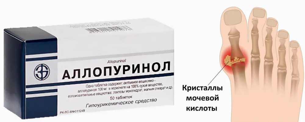 Лекарственное лечение подагры