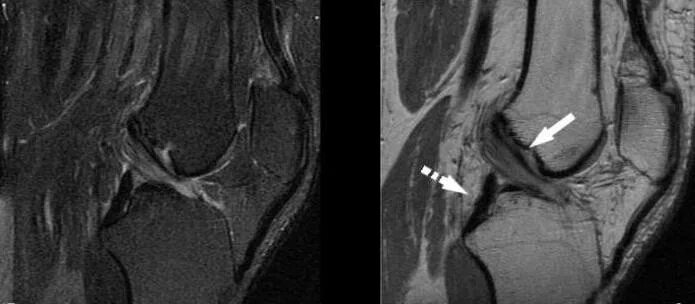 Разрыв мениска мрт. Мрт коленного сустава разрыв мениска. Перелом мениска рентген. Мукоидная дегенерация мениска.