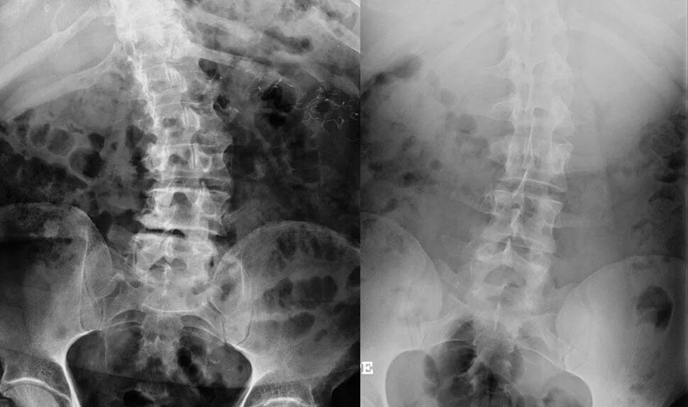 симптомы сколиоза поясничного отдела позвоночника. сколиоз пояснично-крестцового отдела позвоночника симптомы. остеохондроз, сколиоз шейного отдела. правосторонний сколиоз 1 степени поясничного отдела позвоночника. степень искривления позвоночника кифоз.