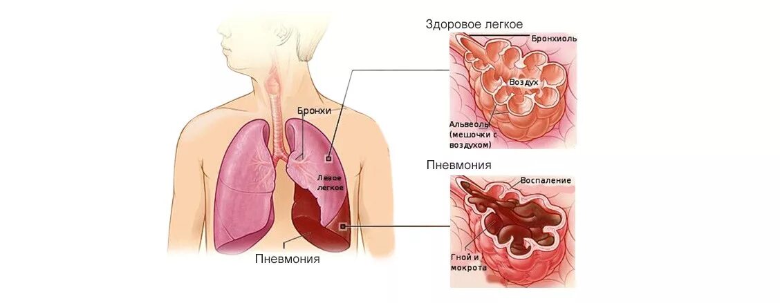 Болезни легких у детей. Заболевания дыхательной системы пневмония. Заболевание легких пневмония. Пневмония это острое инфекционное заболевание.