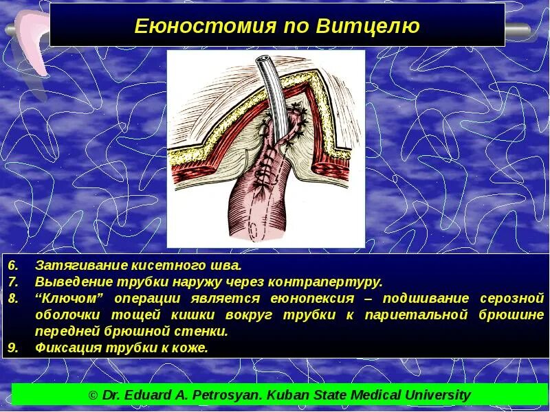 Еюностома это