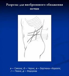 Операция бергмана