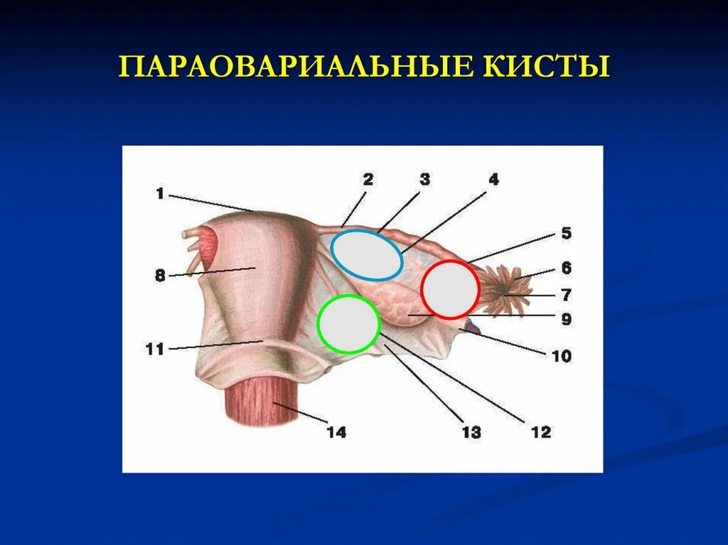 Надо ли удалять параовариальную кисту. Парооравиальные кисты. Перекрут параовариальной кисты. Разрыв параовариальной кисты. Паратубарная и параовариальная киста.