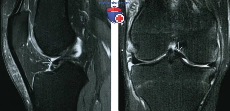 Разрыв мениска ручка лейки мрт. Разрыв латерального мениска по типу ручки лейки. Мрт коленного сустава разрыв мениска.