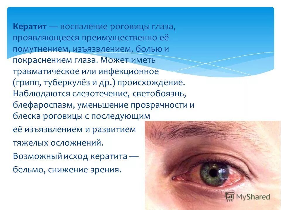 Ограниченный болезненный. Заболевание глаз кератит. Воспаление покраснение глаза.