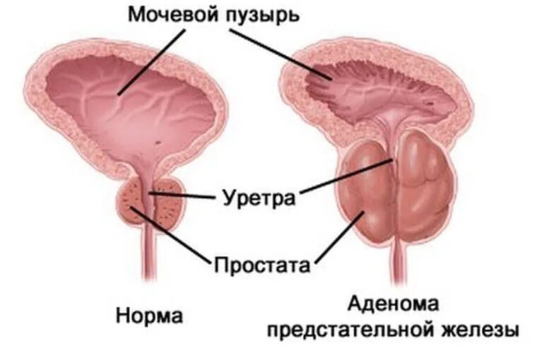 Простата хочет. Доброкачественная гиперплазия предстательной железы.