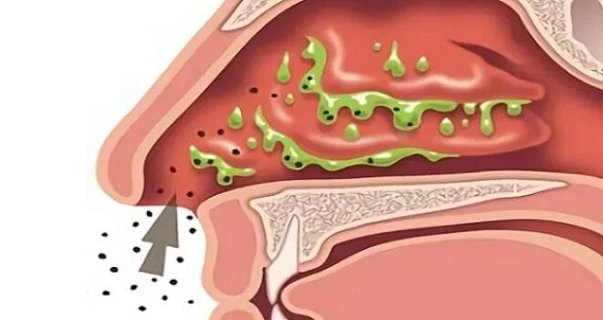 Катаральный насморк. Вазомоторный ринит риноскопия. Хронический катаральный ринит. Слизистая оболочка носа ринит. Острый катаральный ринит.