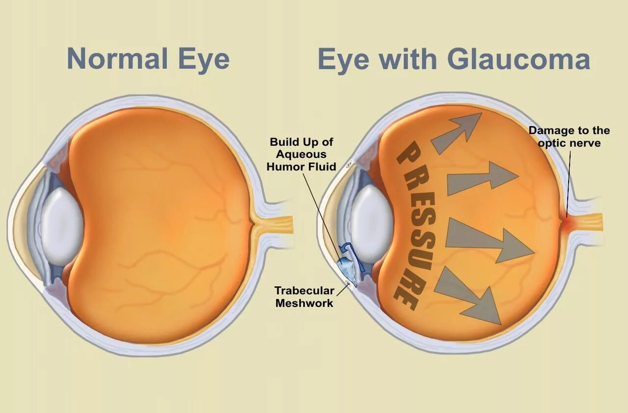 Глазное давление у детей. Глаукома схема. Здоровые глаза. Глаукома схема глаза. Как выглядит здоровый глаз.