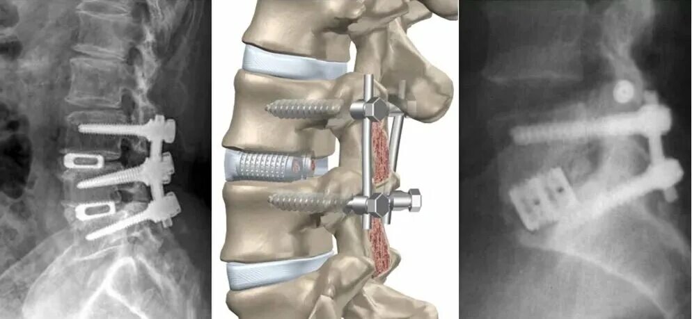 Операция на позвоночник сколько времени. Транспедикулярный остеосинтез. Транспедикулярная фиксация l5-s1 позвонков. Транспедикулярная фиксация th11-l2. Операция антелистез l5.