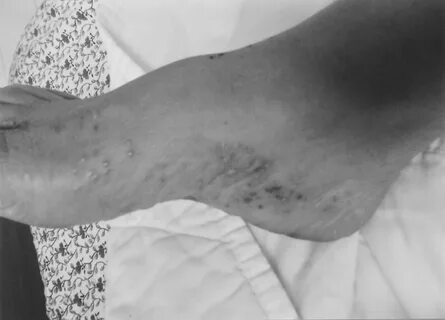 Palmoplantar Pustulosis Psoriasis 