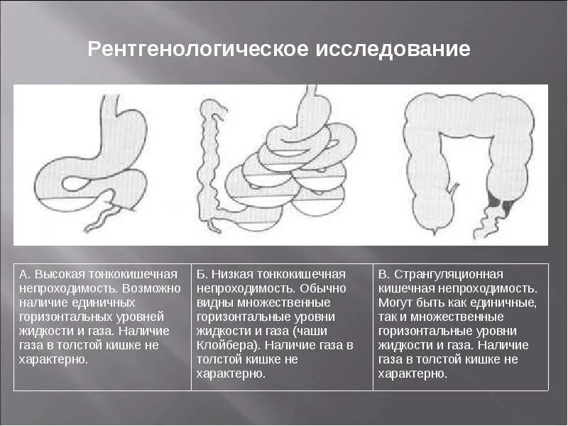 Кишечная непроходимость ирригоскопия. Острая кишечная непроходимость симптомы. Кишечная непроходимость Триада симптомов. Острая кишечная непроходимость уровни.