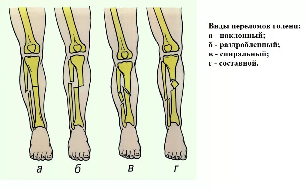 Перелом малой берцовой кости классификация. Перелом голени и малоберцовой кости. Перелом большеберцовой кости. Закрытый перелом нижней трети голени.